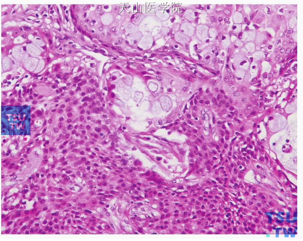 中分化黏液表皮样癌：中间细胞较多
