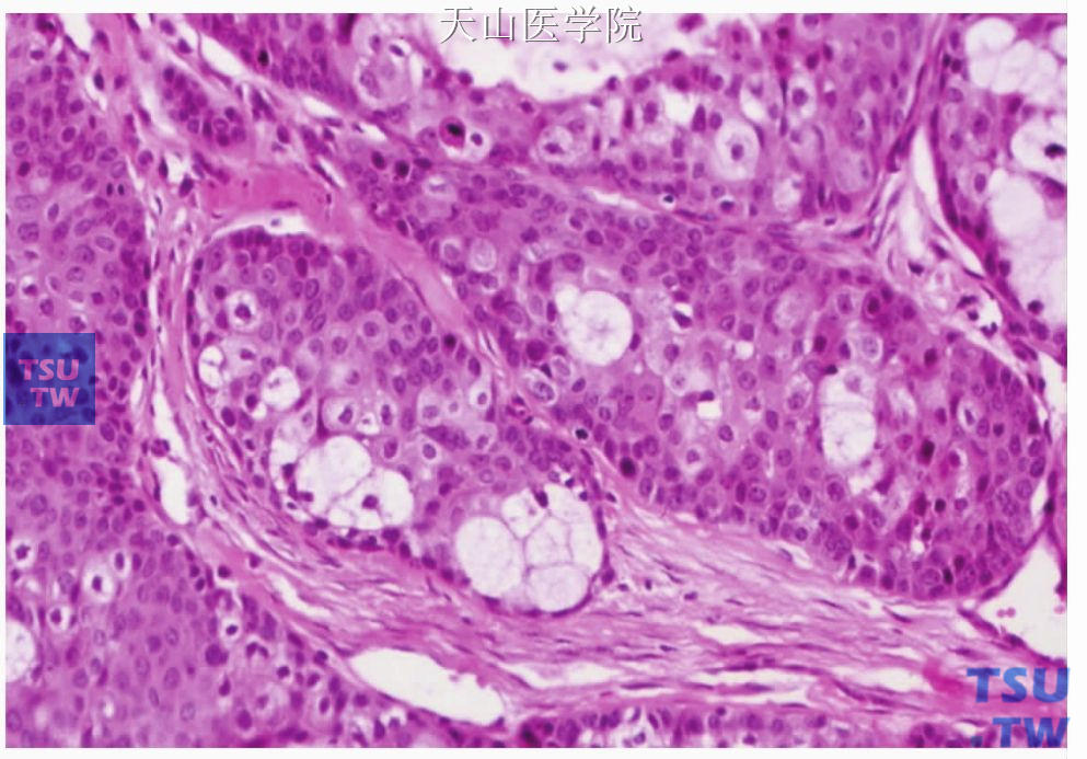 中分化黏液表皮样癌：表皮样细胞较多