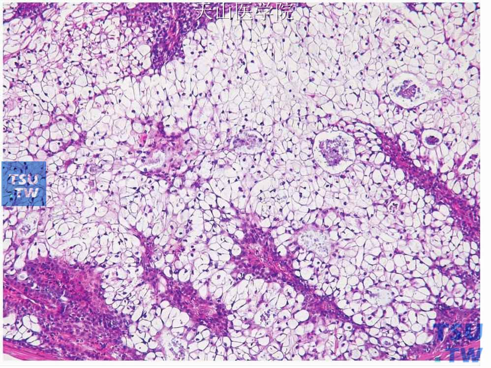 透明细胞型黏液表皮样癌：透明细胞构成肿瘤的大部分