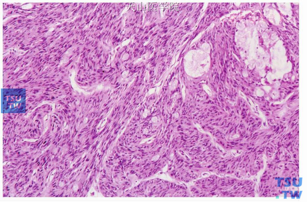 梭形细胞黏液表皮样癌：肿瘤细胞呈梭形，成束状排列，间杂以黏液样细胞