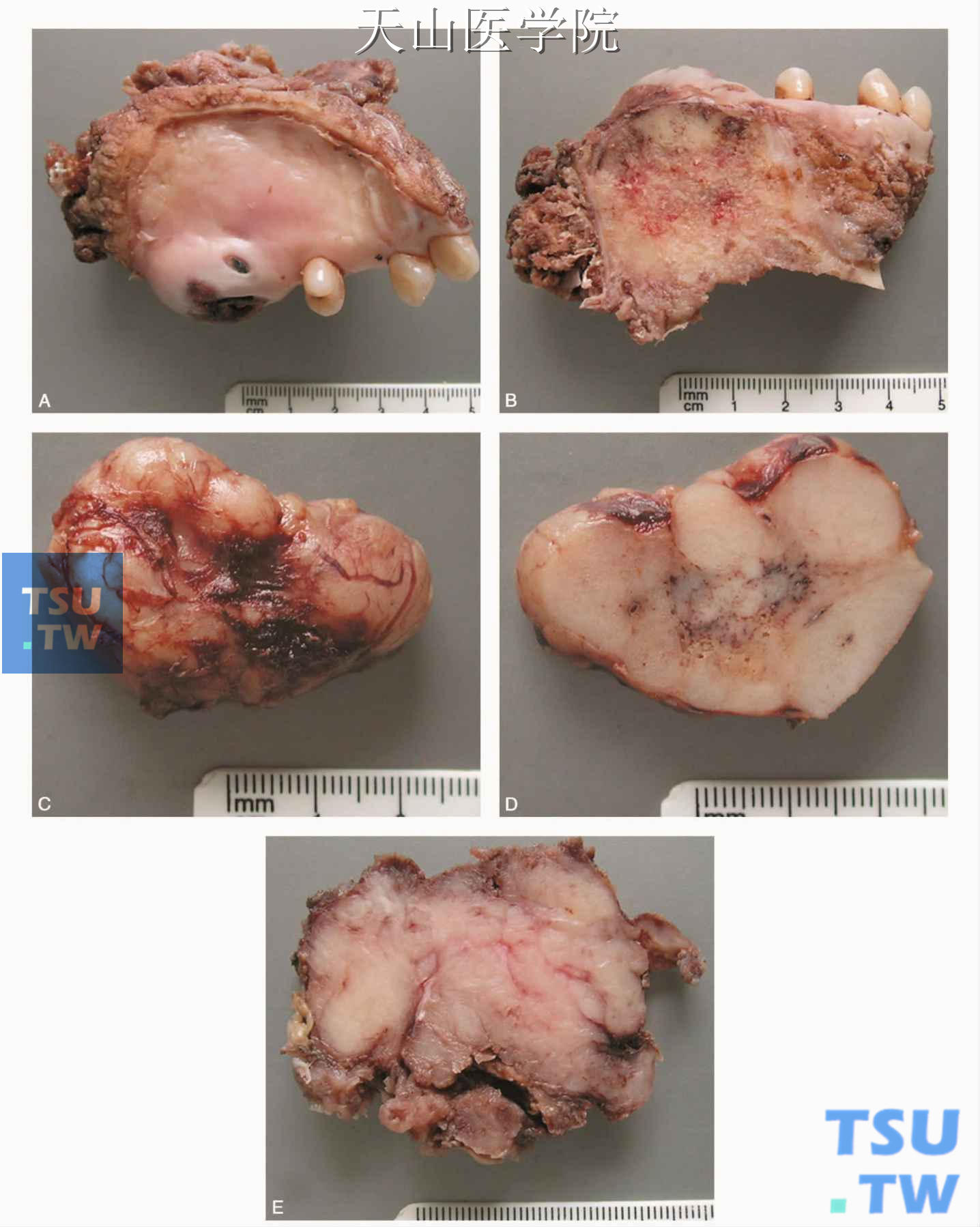 腺样囊性癌的大体观 A、B为同一例，C、D为同一例（罗海燕分切、摄影）