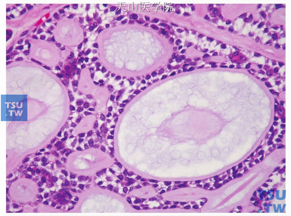 腺样囊性癌：肿瘤细胞大小一致，大部分为肌上皮细胞，胞质少而透明