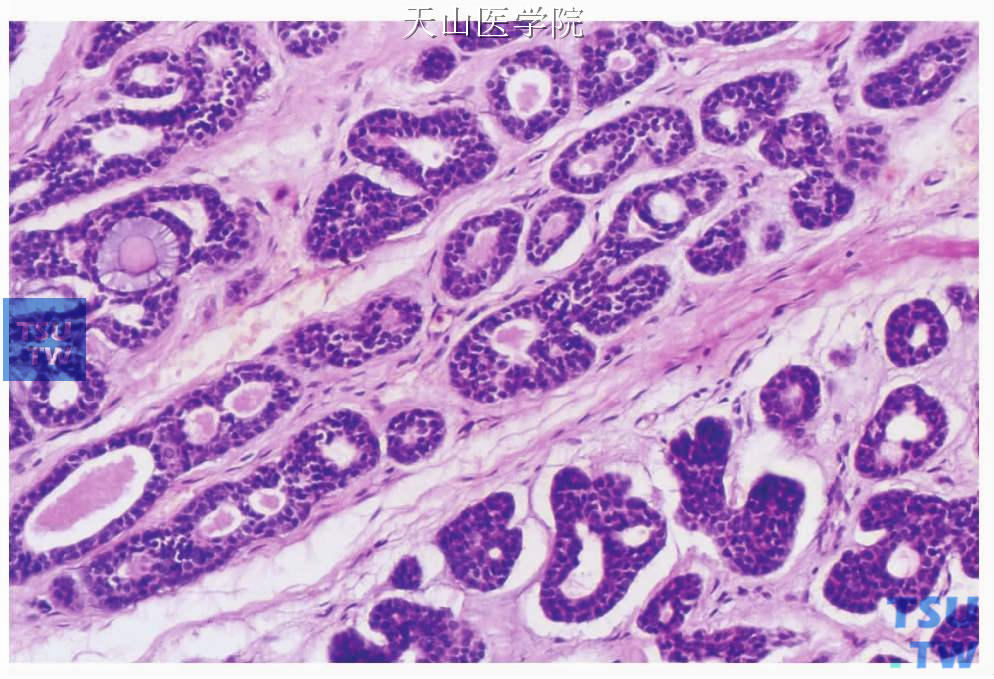 腺样囊性癌：管状型，肿瘤细胞形成管状结构