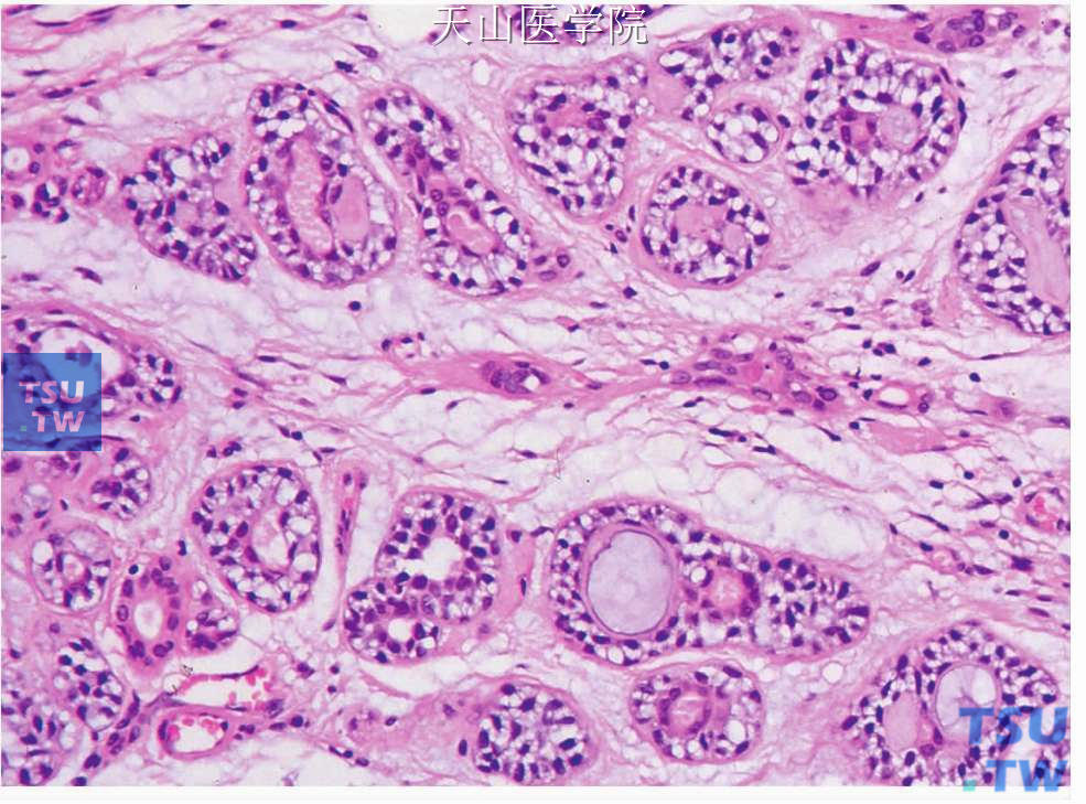 腺样囊性癌 ：管状型，导管内层为小的立方、胞质嗜酸的导管细胞，外有肌上皮细胞围绕