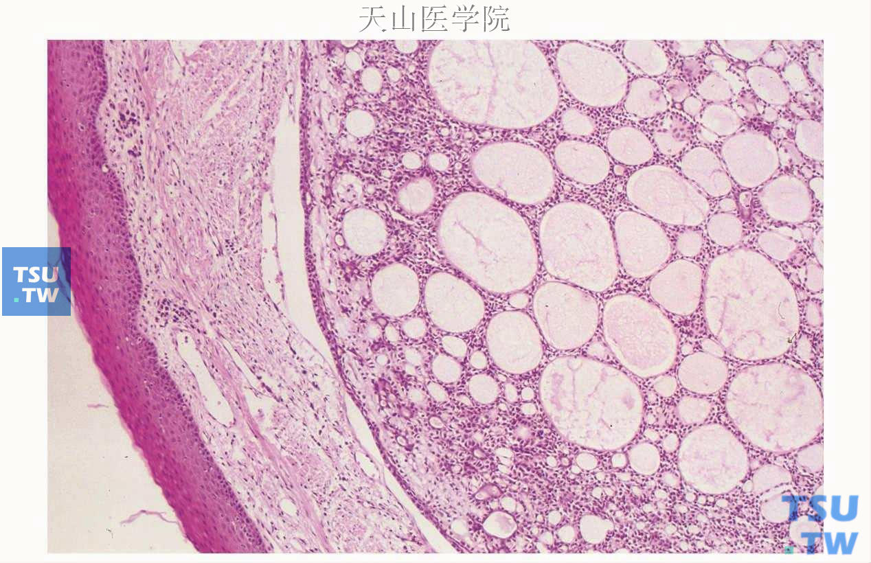 腺样囊性癌：筛状型，肿瘤细胞形成筛状结构