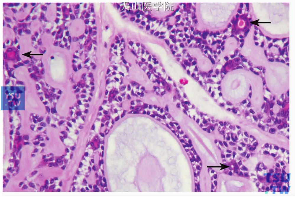 腺样囊性癌 ：筛状型，筛状结构中导管样结构由类似于闰管的小立方细胞构成（箭头）