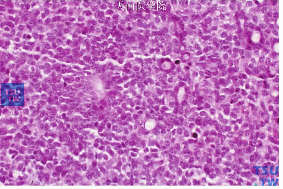 腺样囊性癌：实性型，片状肿瘤细胞中可见导管样结构（右上方）