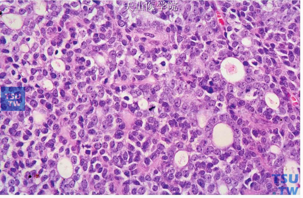 腺样囊性癌：实性型，肿瘤细胞含小核仁，核分裂常见