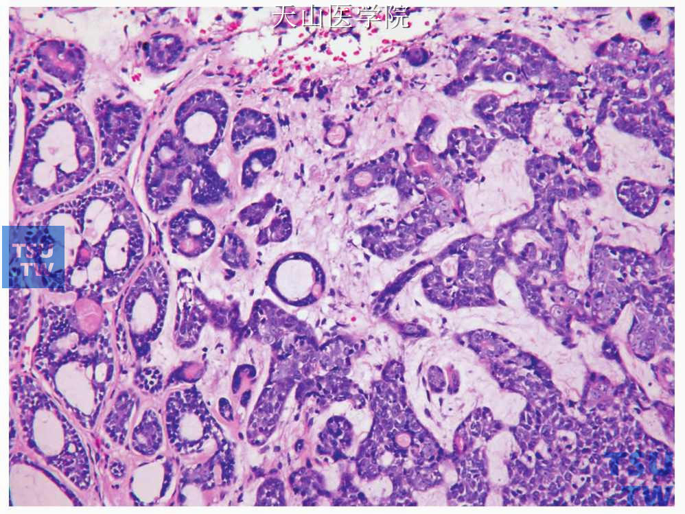 腺样囊性癌高级别转化：腺上皮细胞增生明显（右侧）
