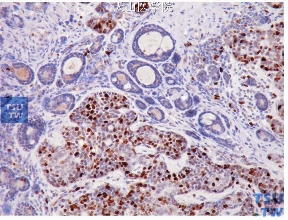 腺样囊性癌高级别转化：高级别转化部分的Ki67阳性细胞明显多于非转化部分