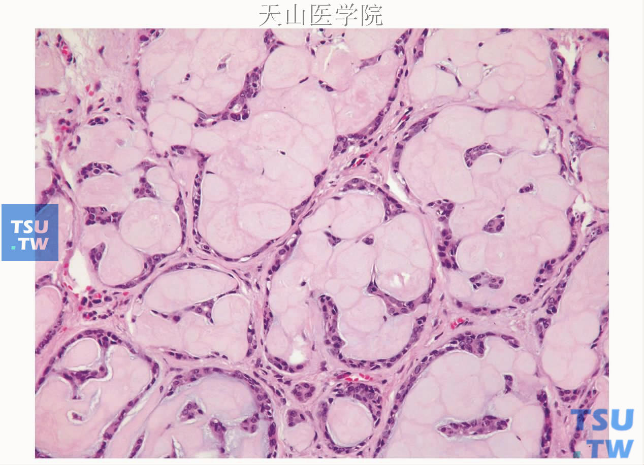 硬化性腺样囊性癌：大量细胞外基质及少许肿瘤细胞