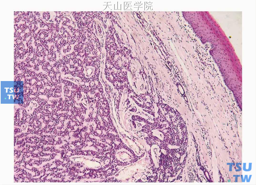 多形性低度恶性腺癌：肿瘤无包膜，呈浸润性生长