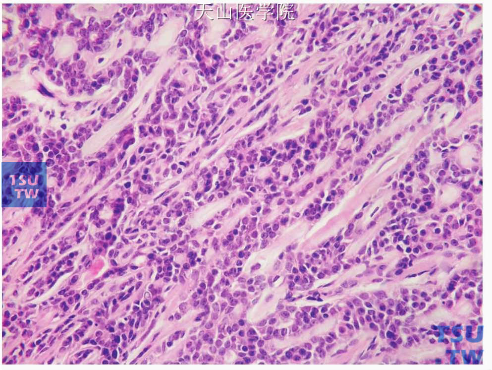 多形性低度恶性腺癌：肿瘤细胞大小一致，核分裂少见