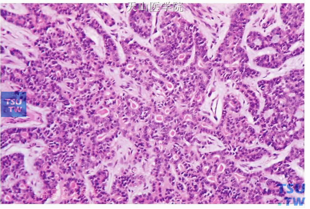 多形性低度恶性腺癌：肿瘤细胞形成吻合的条索，其间见导管样分化