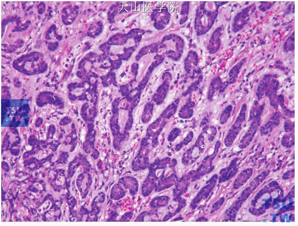 多形性低度恶性腺癌：肿瘤细胞排列成梁状
