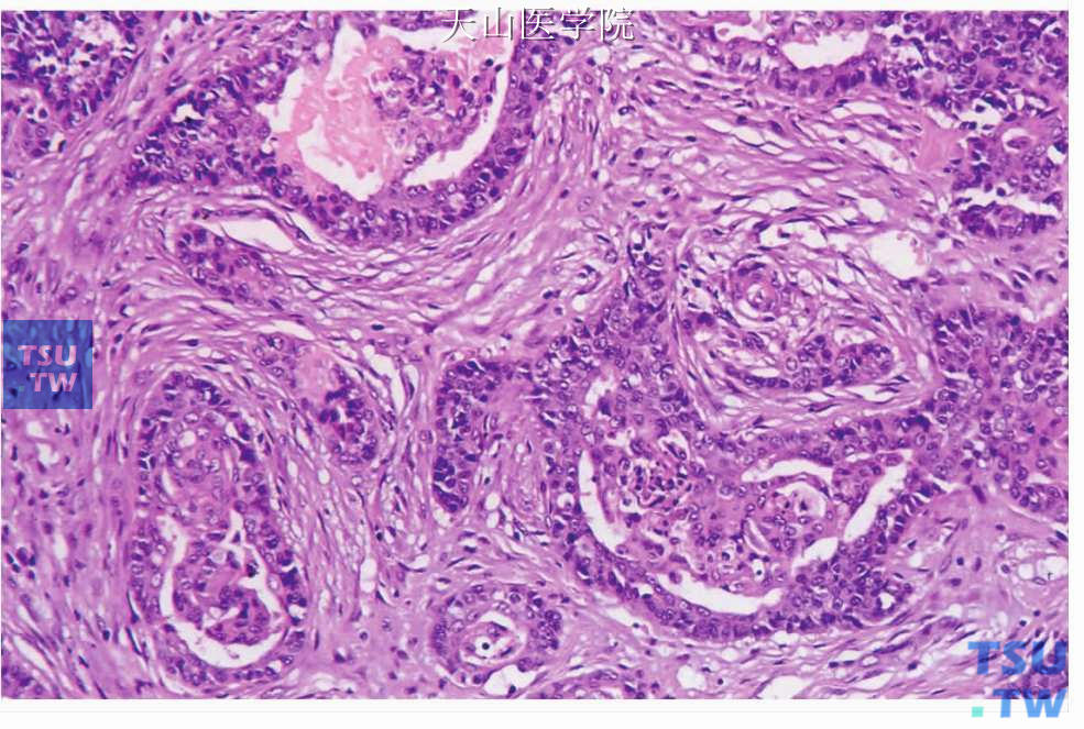 多形性低度恶性腺癌：肿瘤形成的乳头状结构