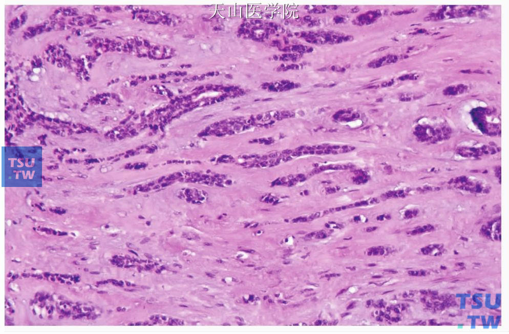 多形性低度恶性腺癌：肿瘤细胞的单列排列和溪流样结构