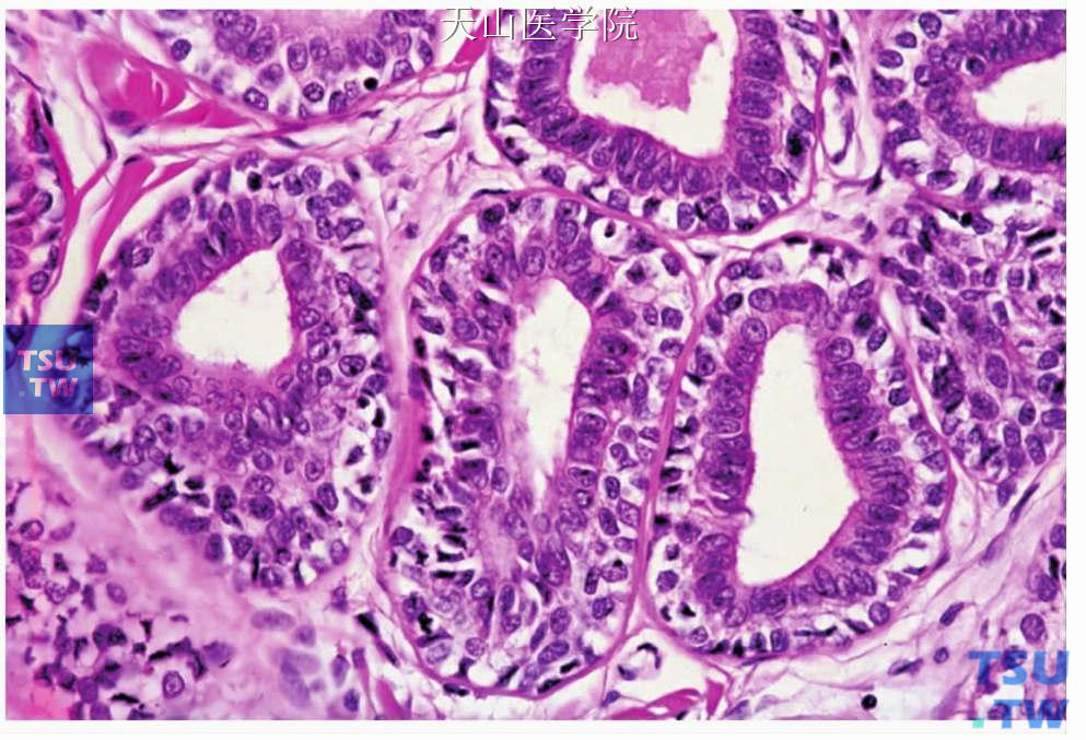 上皮-肌上皮癌：肿瘤细胞排列成管状，内层细胞呈柱状