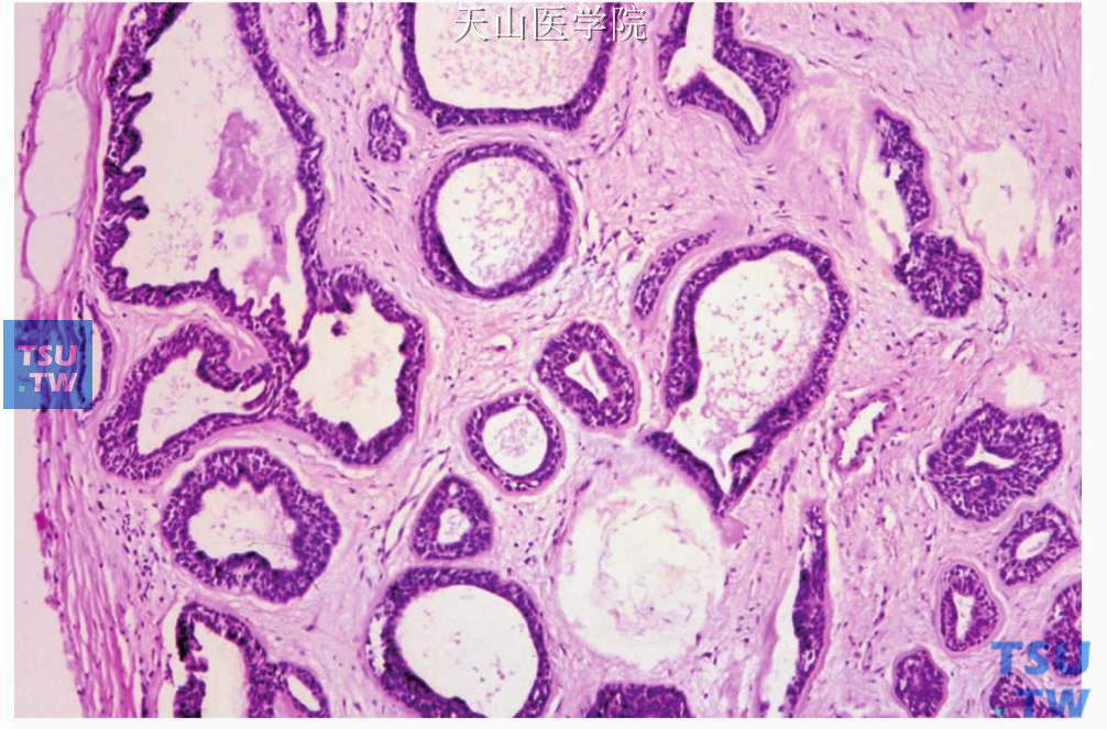 上皮-肌上皮癌：肿瘤局部有包膜（左侧），导管扩张形成囊腔，部分囊腔内有乳头突入