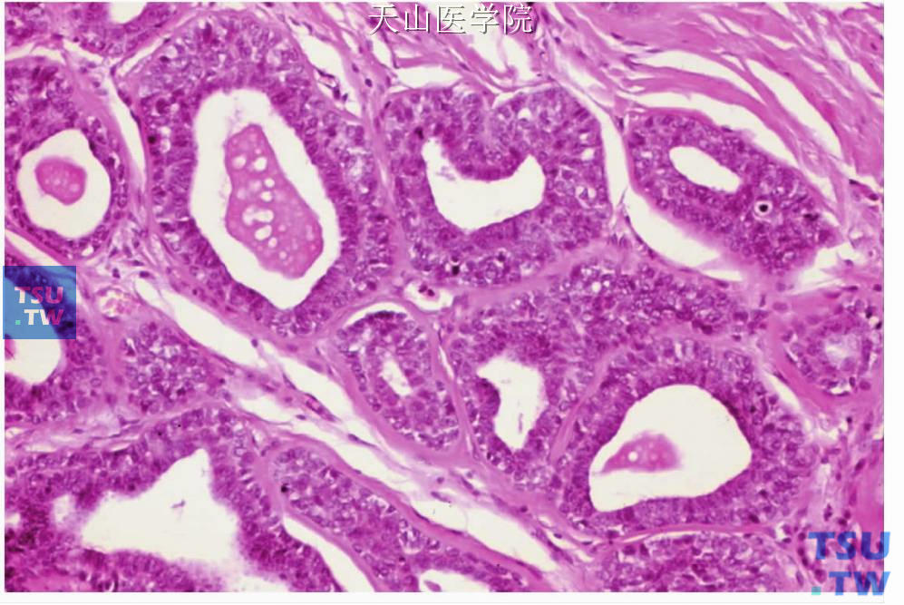 上皮-肌上皮癌：管状结构的外层细胞胞质不透明
