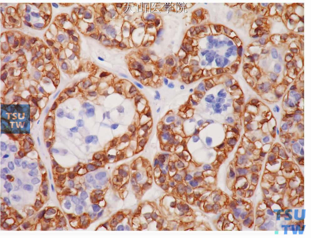 双透明型上皮-肌上皮癌：管状结构外层细胞胞质调宁蛋白阳性，内层细胞阴性，免疫组化染色