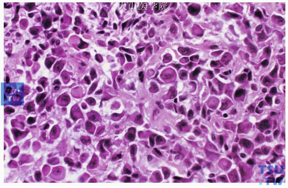 上皮-肌上皮癌高级别转化：转化成份为具有多形性的浆样肌上皮细胞