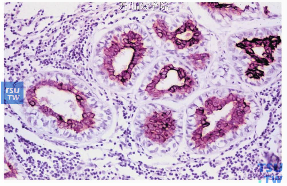 上皮-肌上皮癌：管状结构内层细胞CK（AE1/3）阳性，免疫组化染色