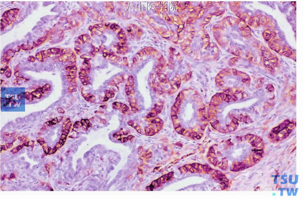 上皮-肌上皮癌：管状结构外层细胞SMA阳性，免疫组化染色