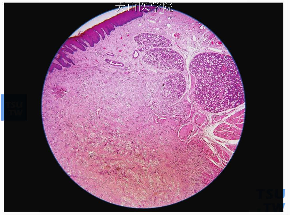 非特异性透明细胞癌：发生在小唾液腺，肿瘤无包膜