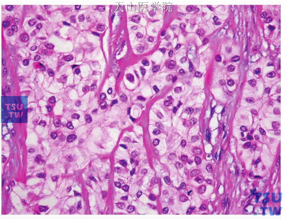 非特异性透明细胞癌：肿瘤细胞大而透明