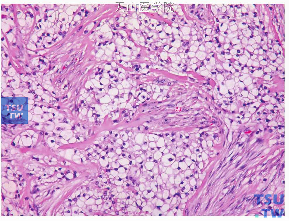 非特异性透明细胞癌：肿瘤细胞排列成巢、片，之间为致密的胶原带分隔