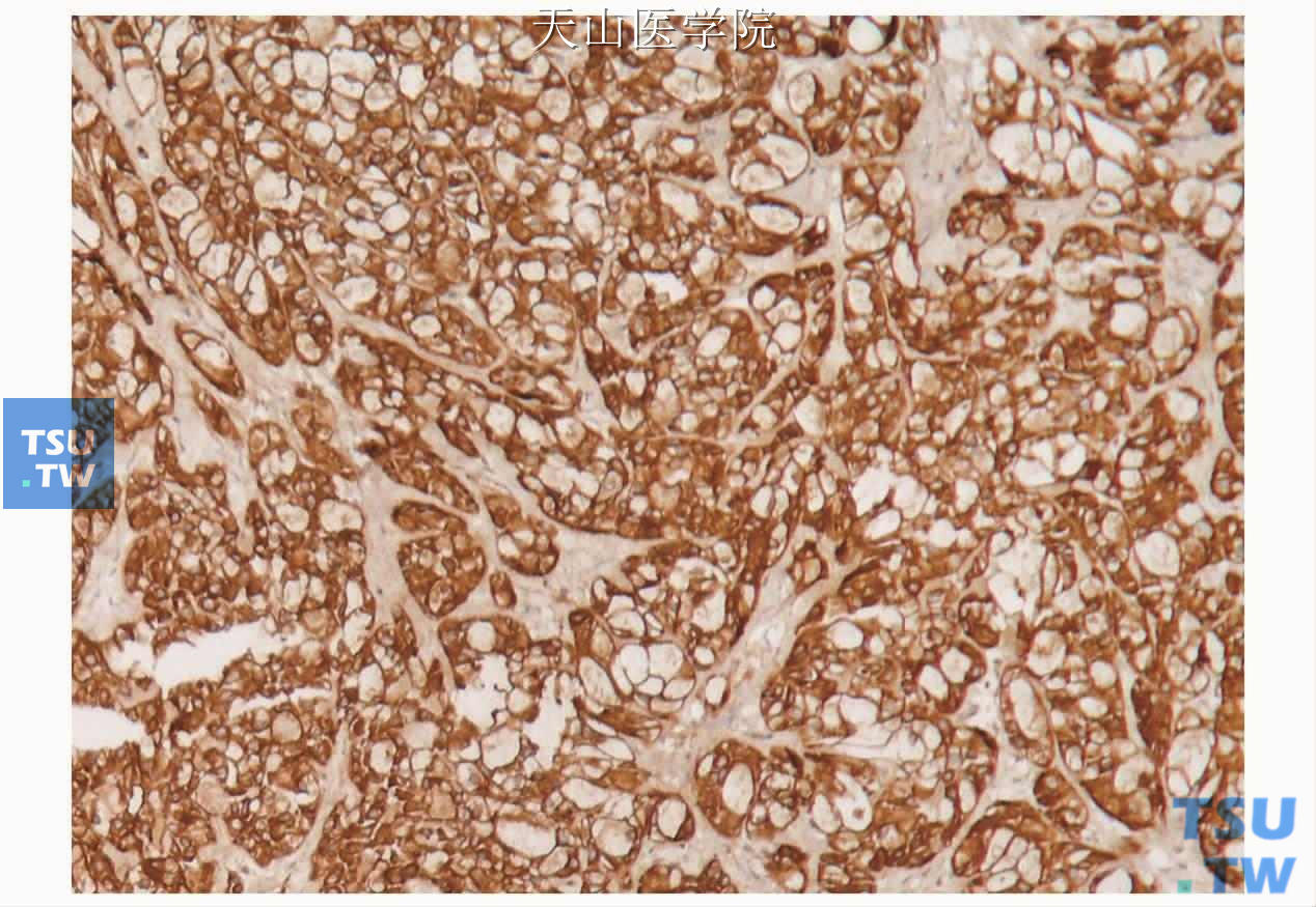 非特异性透明细胞癌：透明细胞表达全角蛋白（AE1/3），免疫组化染色