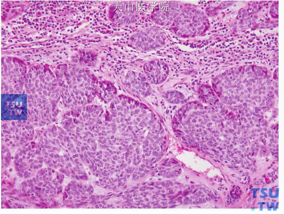 基底细胞腺癌：肿瘤浸润性生长