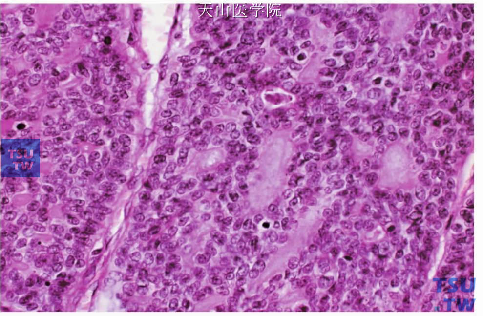 实性型基底细胞腺癌：肿瘤岛周边细胞排列整齐