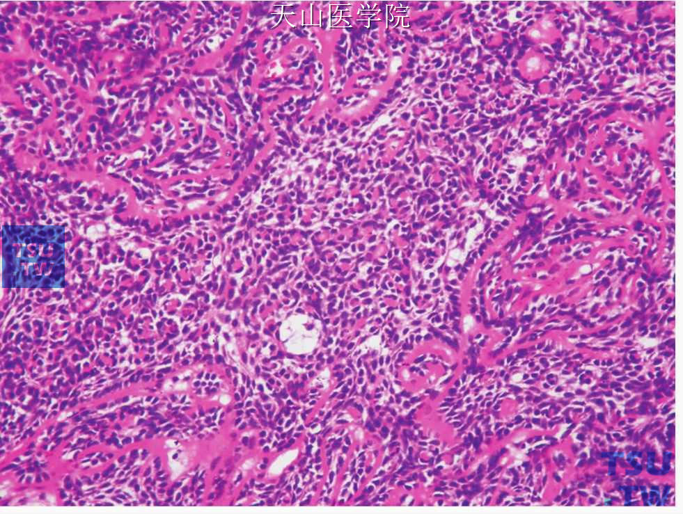 基底细胞腺癌：肿瘤细胞类似于成釉细胞瘤的星网状层（中央区）