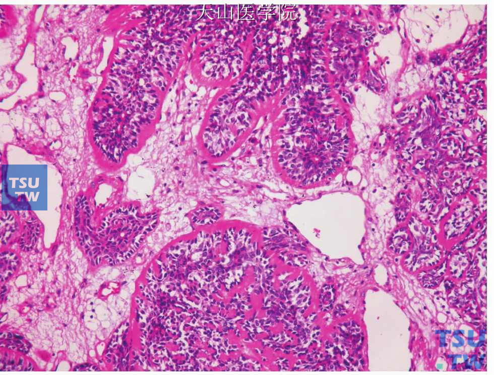 膜性型基底细胞腺癌：肿瘤细胞团被嗜伊红的玻璃样物质围绕