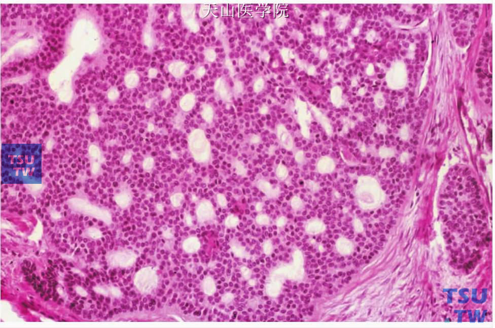 管状型基底细胞腺癌