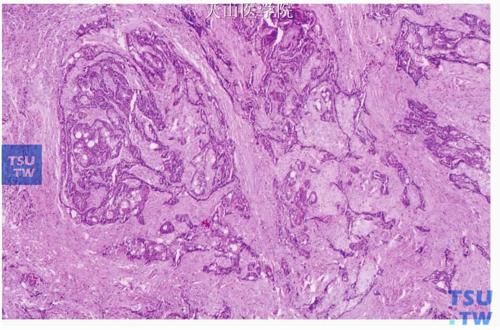 皮脂腺癌：肿瘤细胞形成吻合和条索和小团，内见微囊，浸润性生长