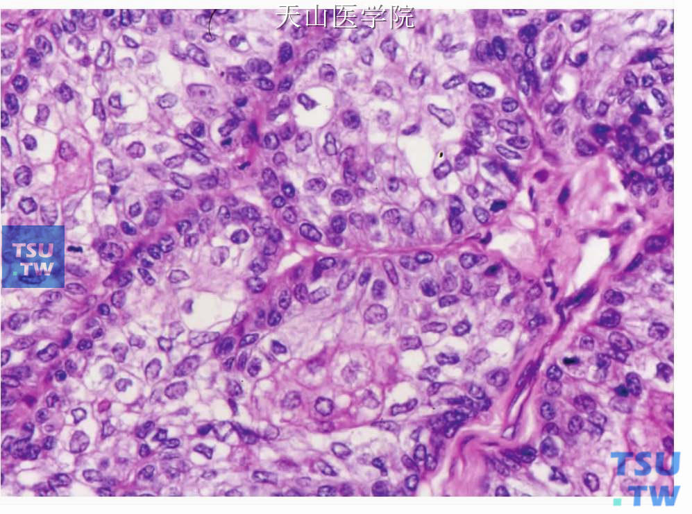 皮脂腺癌：肿瘤细胞团中央细胞胞质含量多，呈网状、明显的皮脂分化；周围细胞较小。核分裂易见