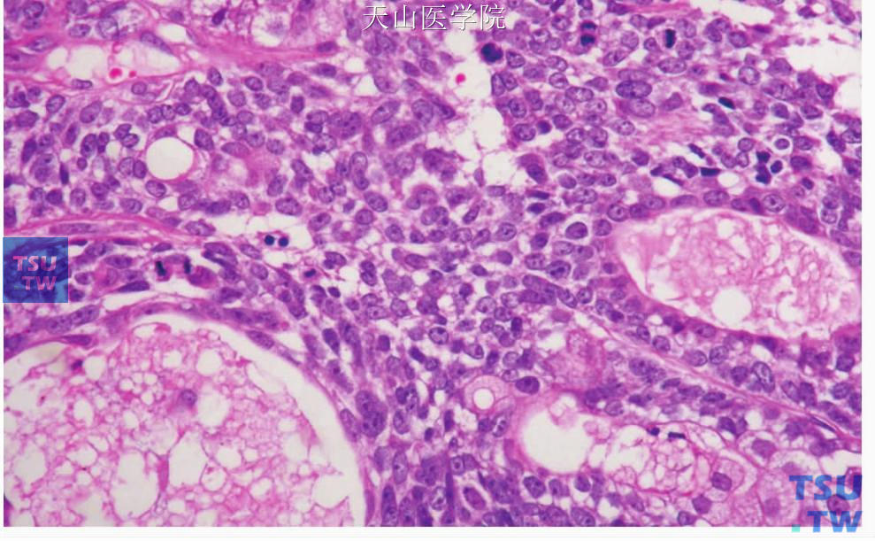 皮脂腺癌 ：囊性腔隙衬复扁平和立方细胞，胞质少，可见核仁。囊腔内含嗜酸性物质。核分裂多见。右下角可见皮脂样细胞