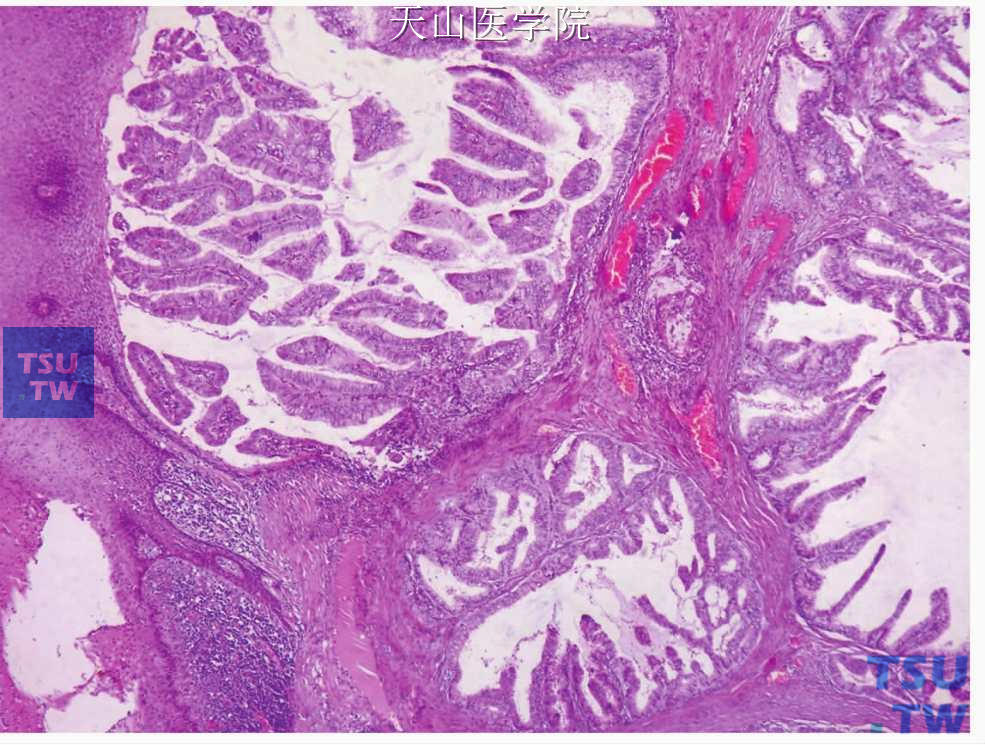 囊腺癌：肿瘤浸润性生长达黏膜上皮