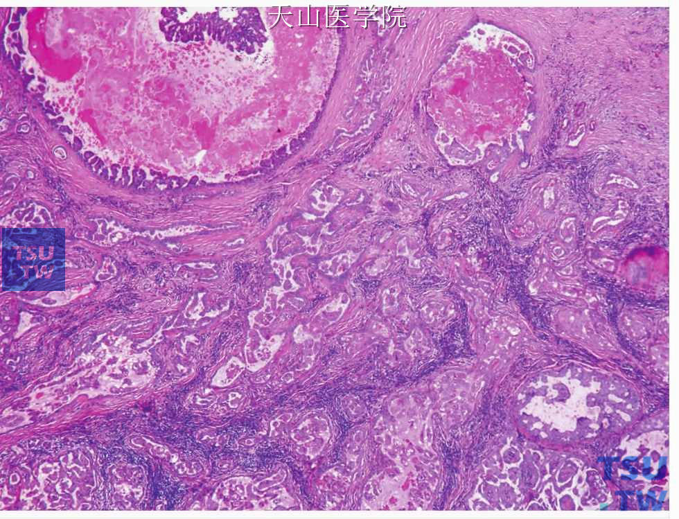 囊腺癌：肿瘤形成大小不等的囊腔，内含乳头突起