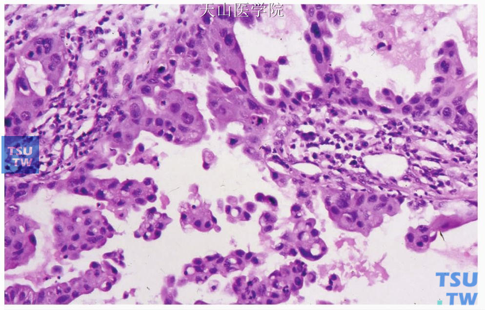 囊腺癌：肿瘤细胞体积较大，胞质丰富，嗜酸性，胞核有核异型性及浓染