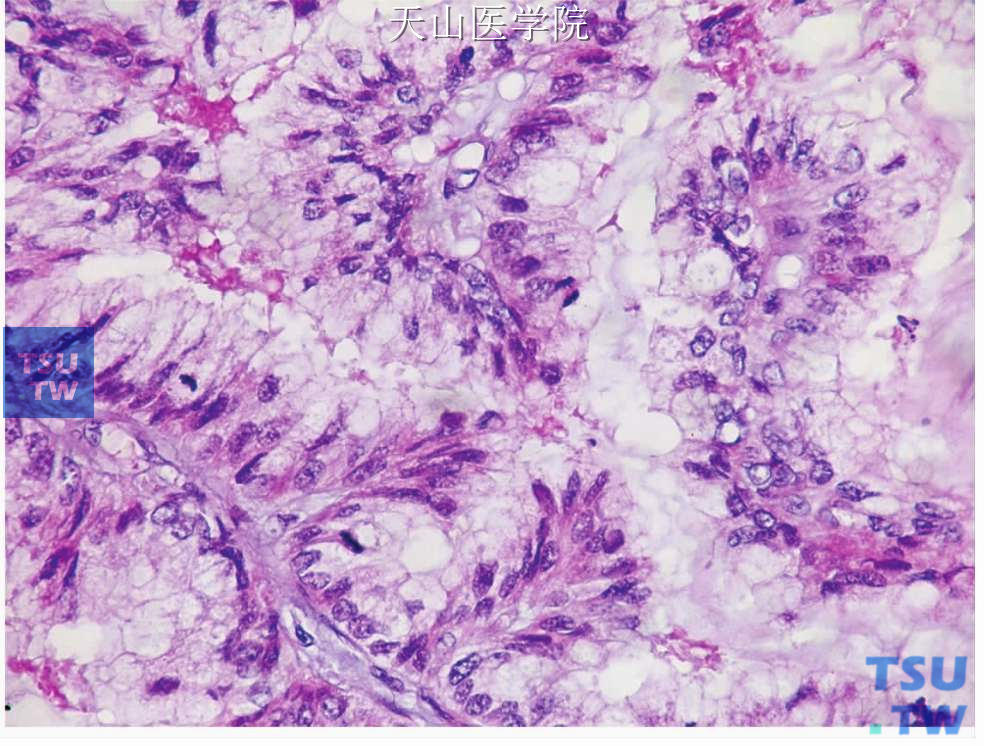 囊腺癌：衬覆乳头的肿瘤细胞呈黏液样，核分裂易见