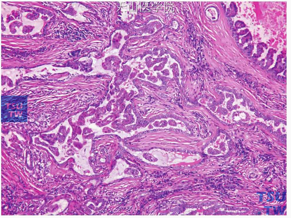 囊腺癌：肿瘤间质见纤维化及炎症细胞浸润