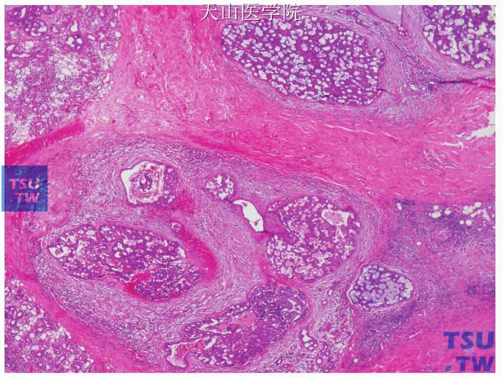 低度恶性筛状囊腺癌：肿瘤无包膜，形成包括小囊在内的多个病灶