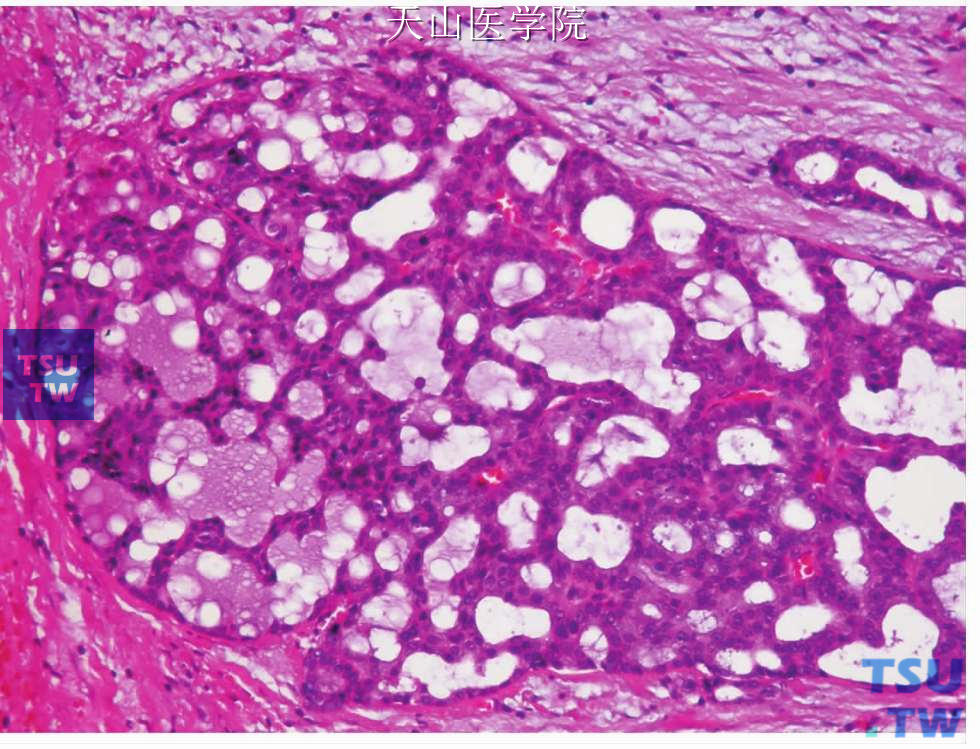 低度恶性筛状囊腺癌：大小一致的细胞形成乳头至筛状结构