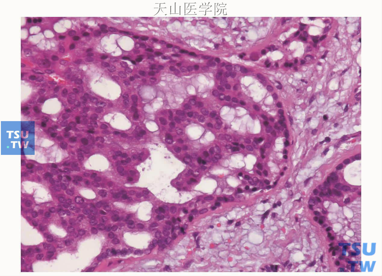 低度恶性筛状囊腺癌：肿瘤细胞团的外围细胞较小