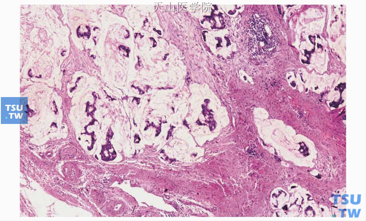 黏液腺癌：肿瘤形成多个黏液池，之间有粗大的胶原纤维间隔