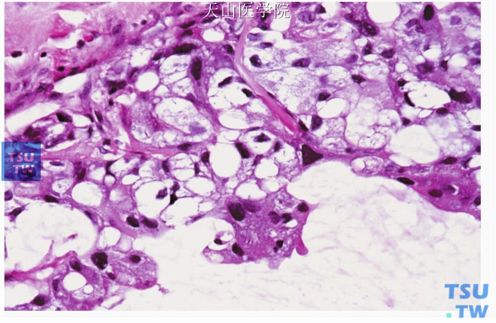 黏液腺癌：肿瘤细胞核不规则，有较明显的异型性